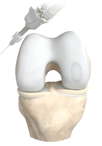 Illustration of ChondroFiller Liquid application to a focal knee cartilage defect